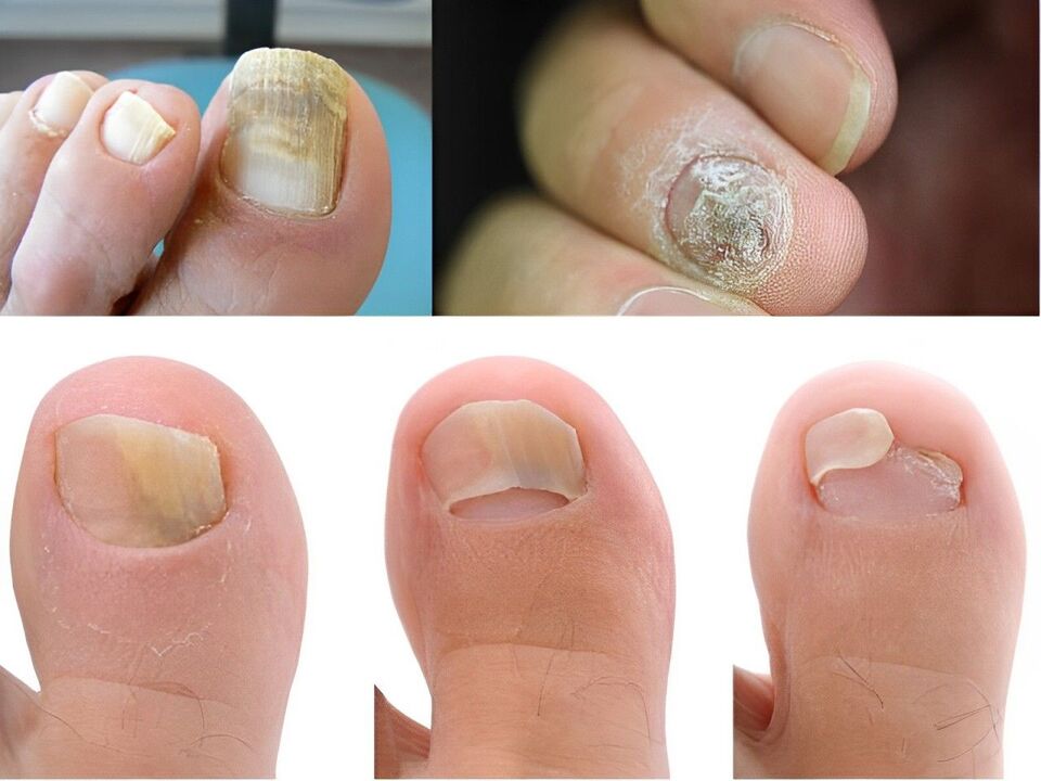 az onychomycosis stádiuma